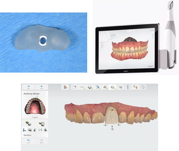 Intra-oral digital scanner